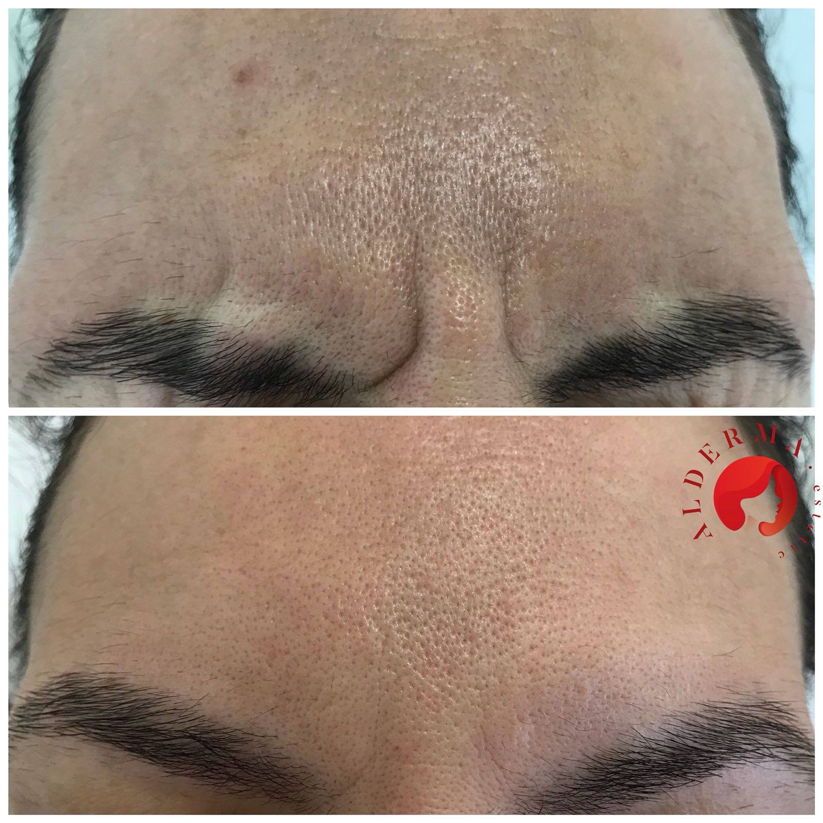 botox 4