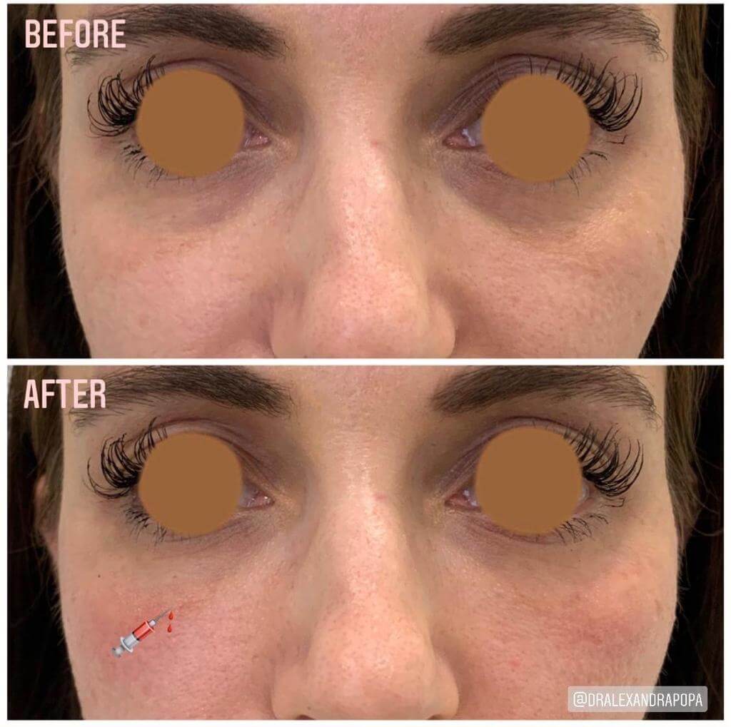 corectie cearcane acid hialuronic constanta (1)