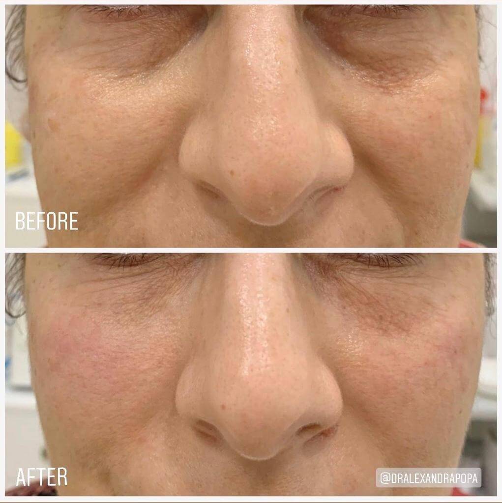 corectie cearcane acid hialuronic constanta (2)