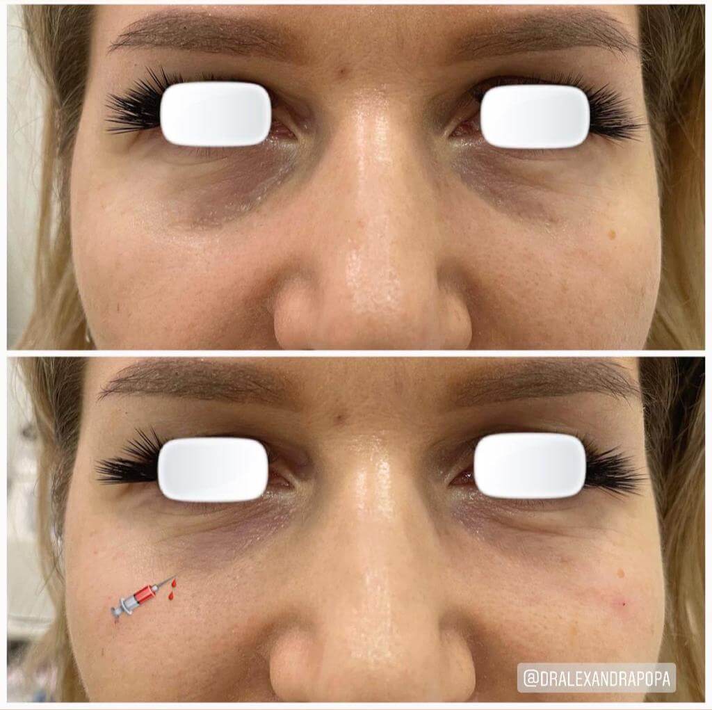 corectie cearcane acid hialuronic constanta (3)