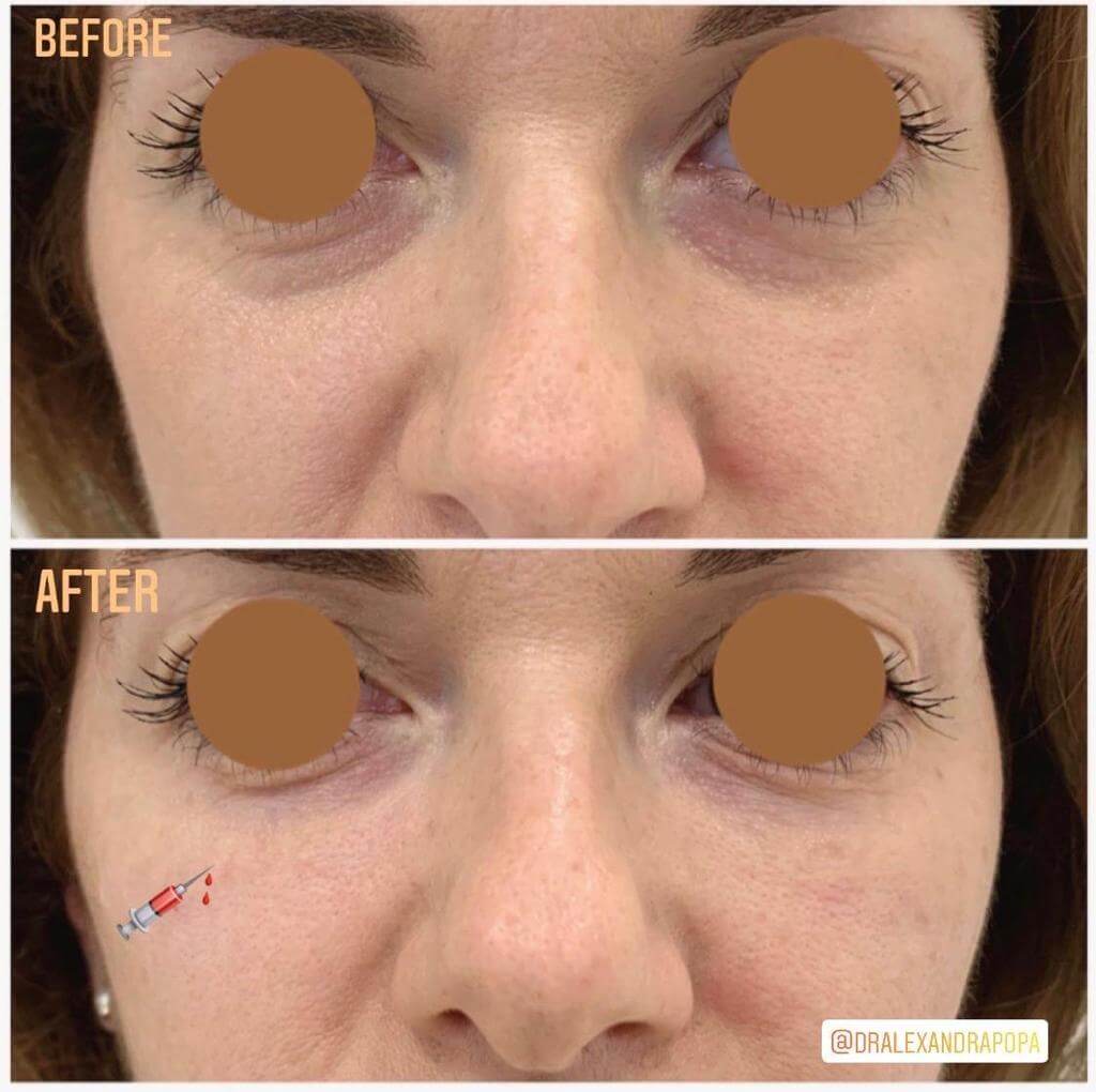 corectie cearcane acid hialuronic constanta (4)