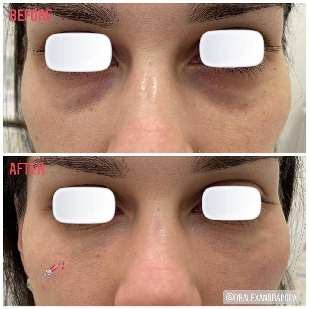 corectie cearcane acid hialuronic constanta (5)