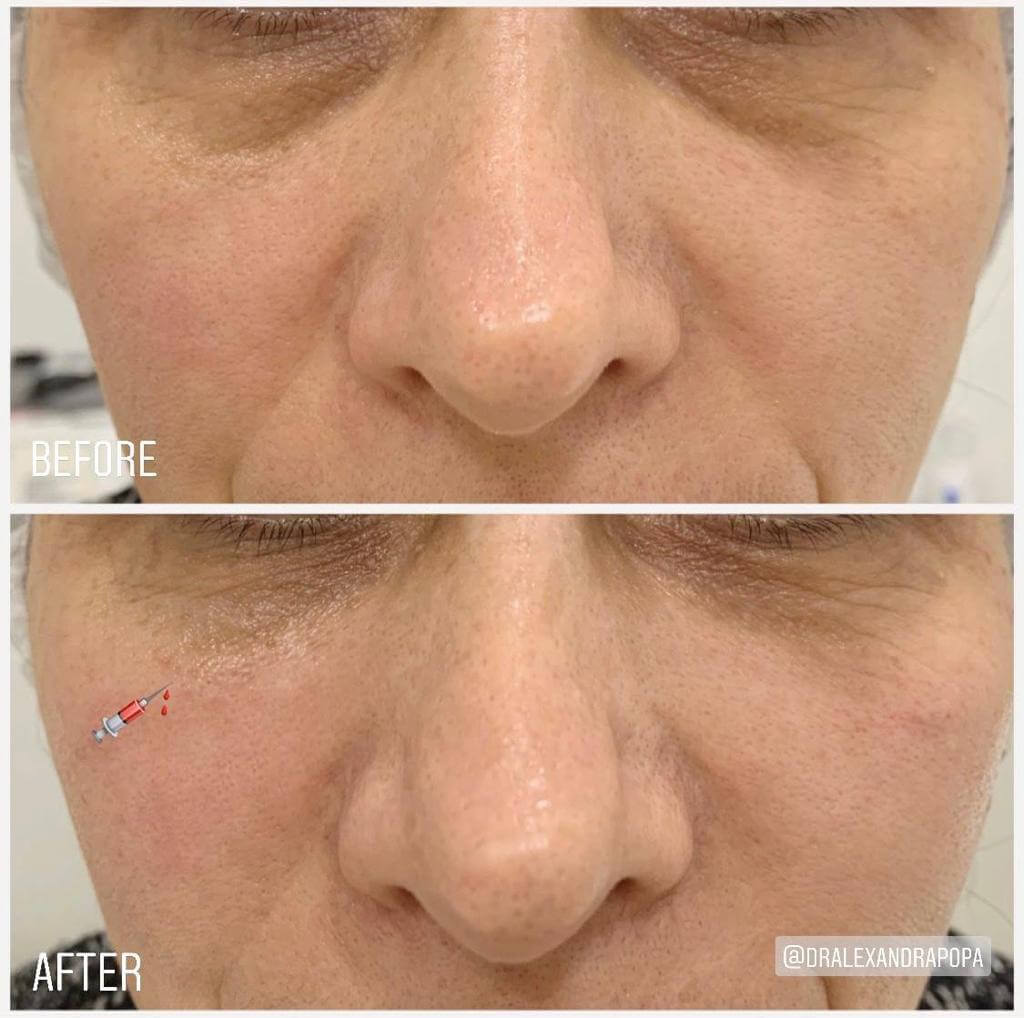 corectie cearcane acid hialuronic constanta (6)
