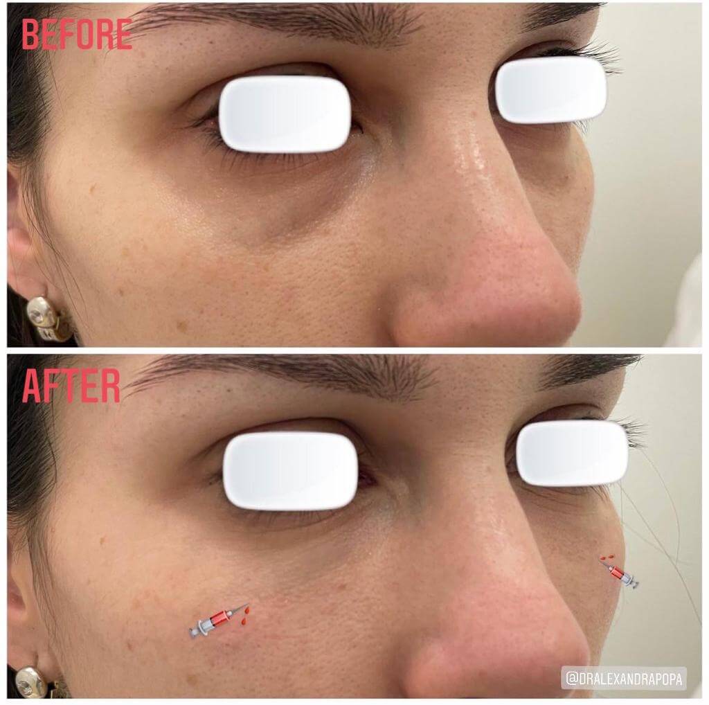corectie cearcane acid hialuronic constanta (7)