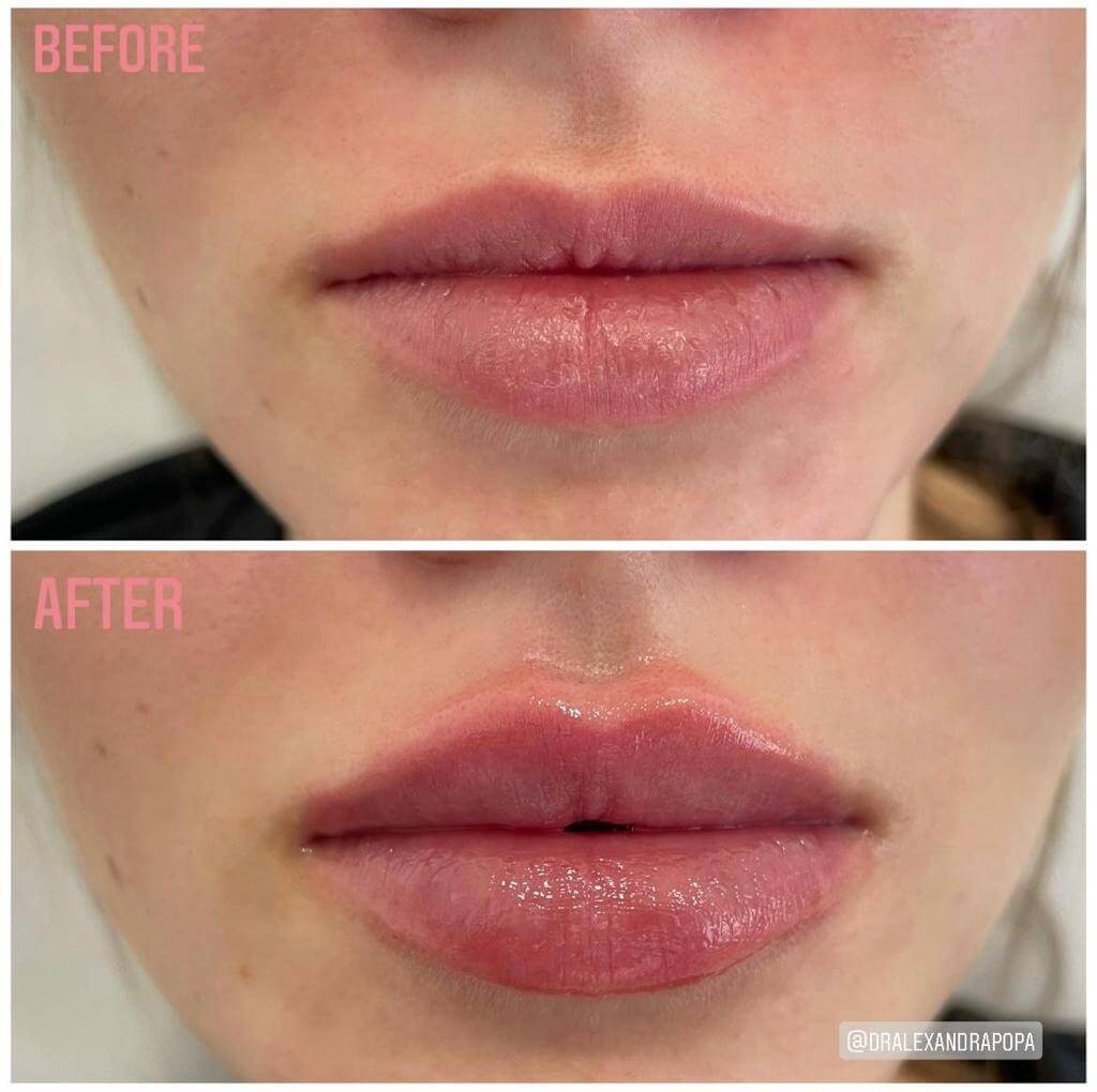 injectare marire buze acid hialuronic alderma constanta (2)