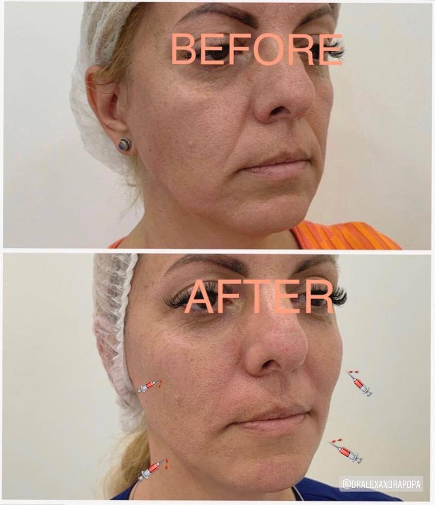 injectari acid hialuronic alderma constanta (11)