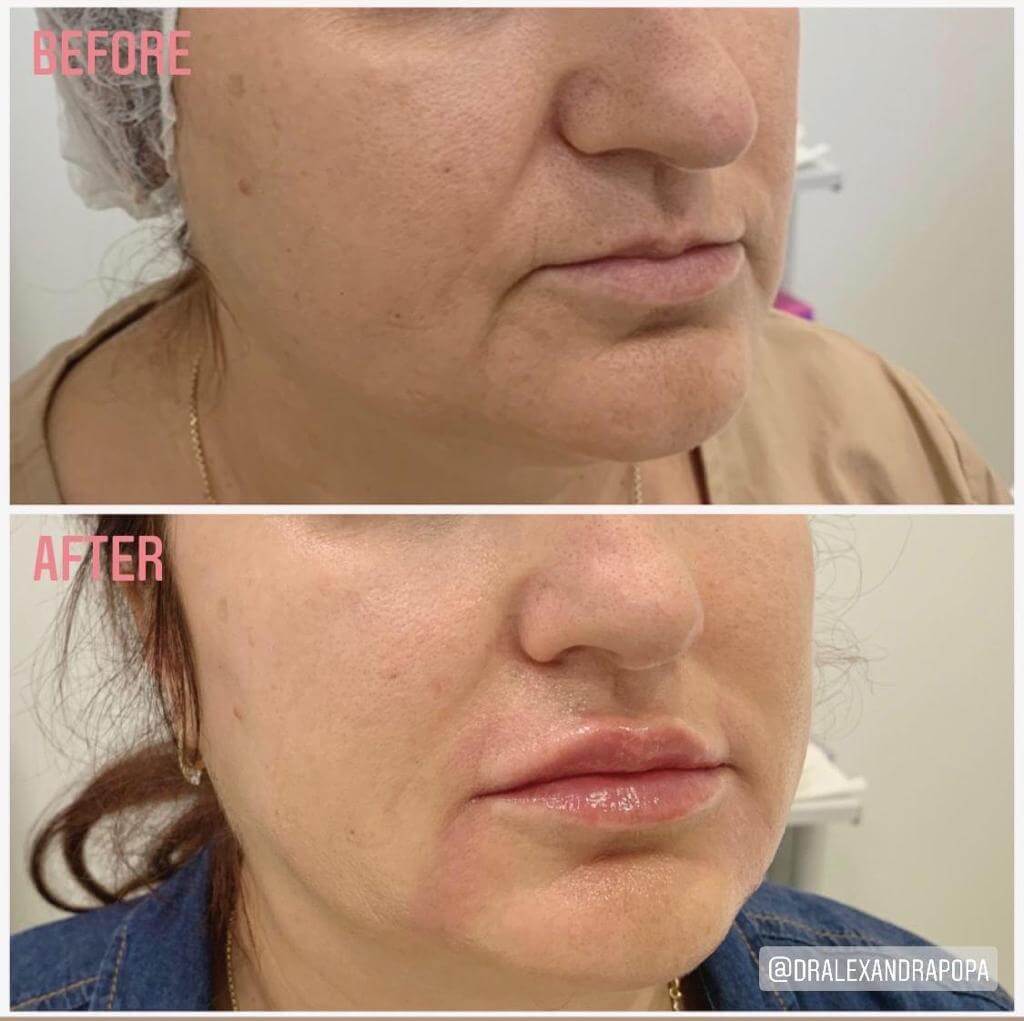 injectari acid hialuronic alderma constanta (4)