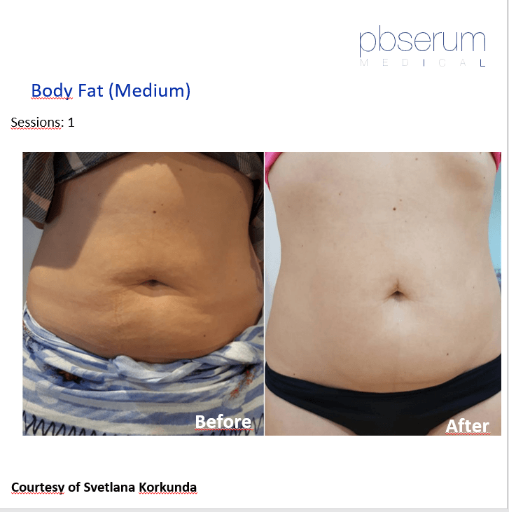 abdomen liposuctie 1