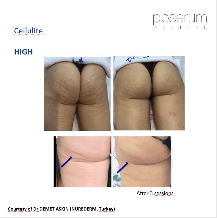 fese celulita alderma 2