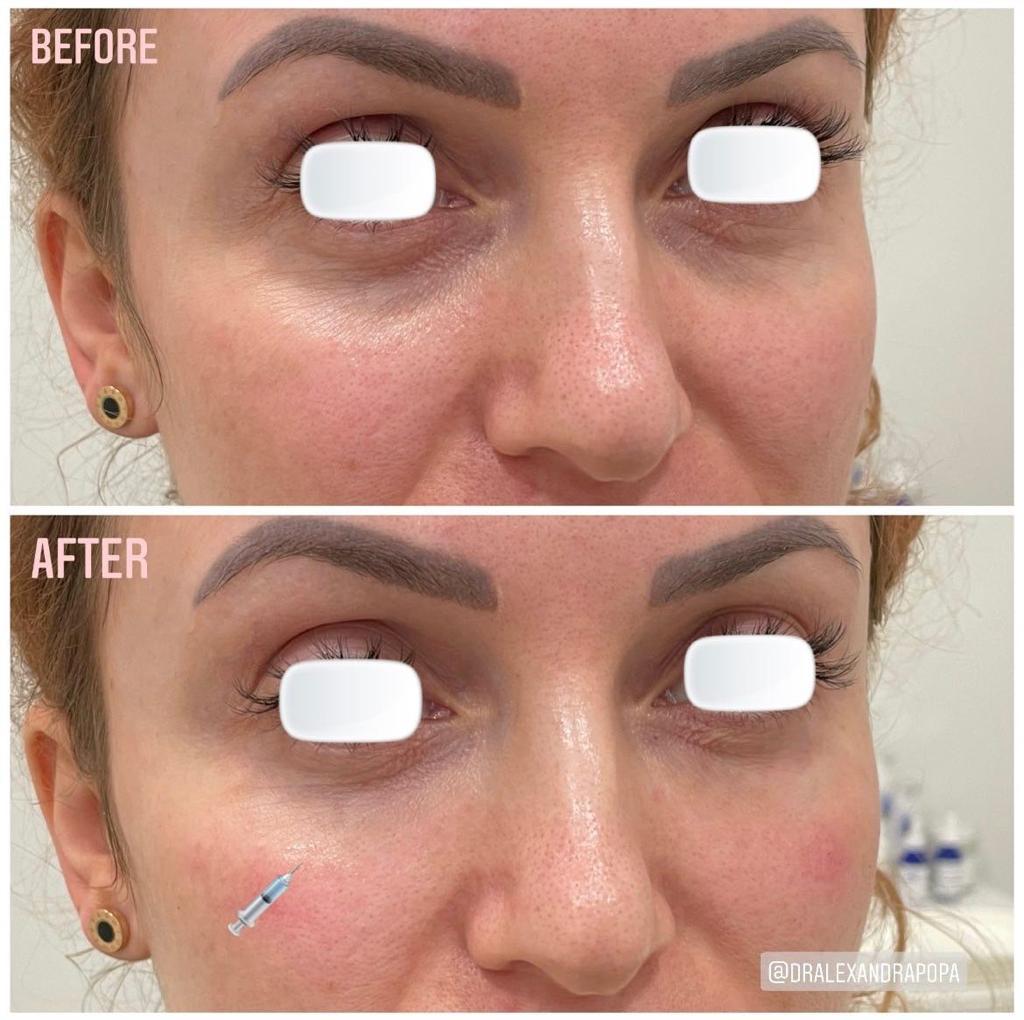 corectie cearcane cu acid hialuronic alderma constanta 12 (1)