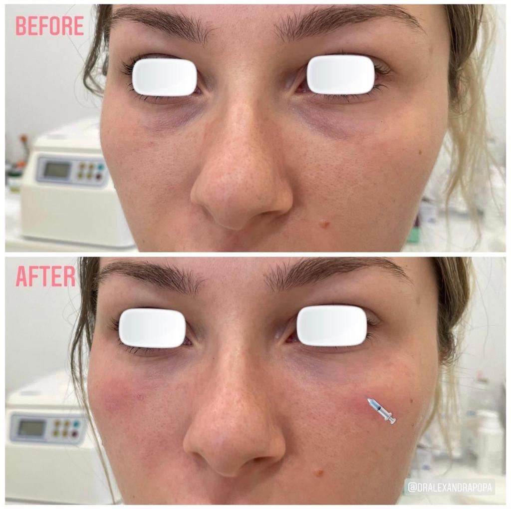 corectie cearcane cu acid hialuronic alderma constanta 12 (5)