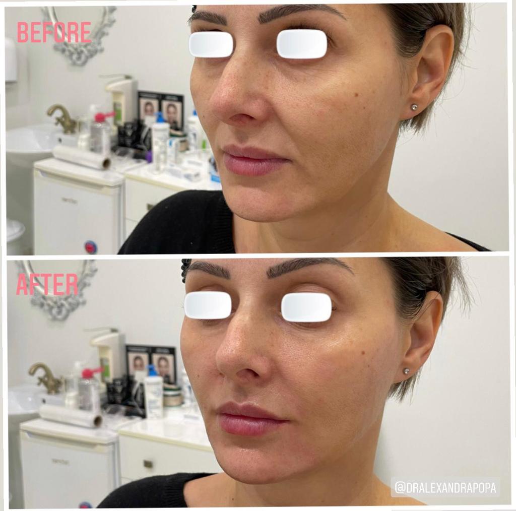 injectari acid hialuronic alderma constanta 11 (1)