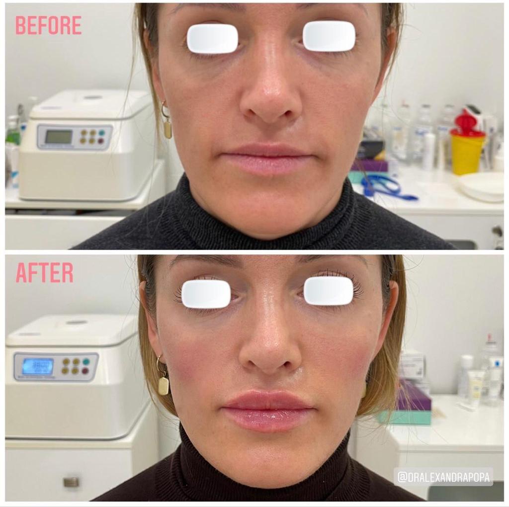 injectari acid hialuronic alderma constanta 11 (2)