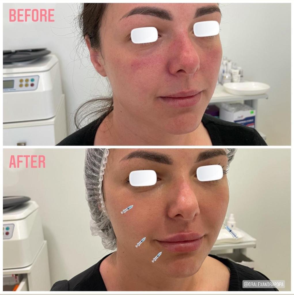 injectari acid hialuronic alderma constanta 11 (3)