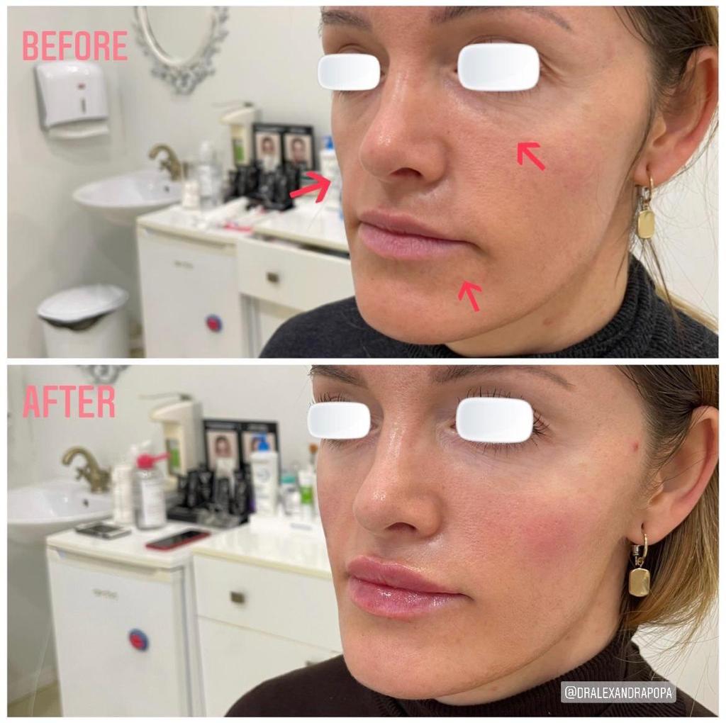 injectari acid hialuronic alderma constanta 22 (2)