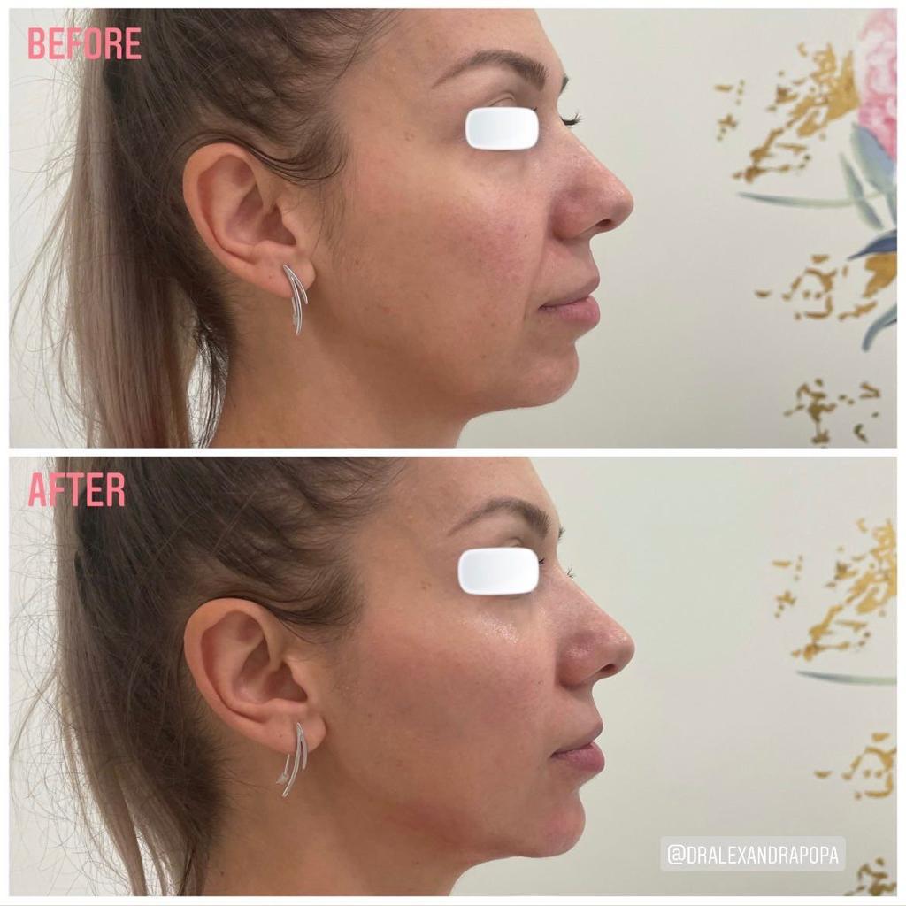 injectari acid hialuronic alderma constanta 22 (3)
