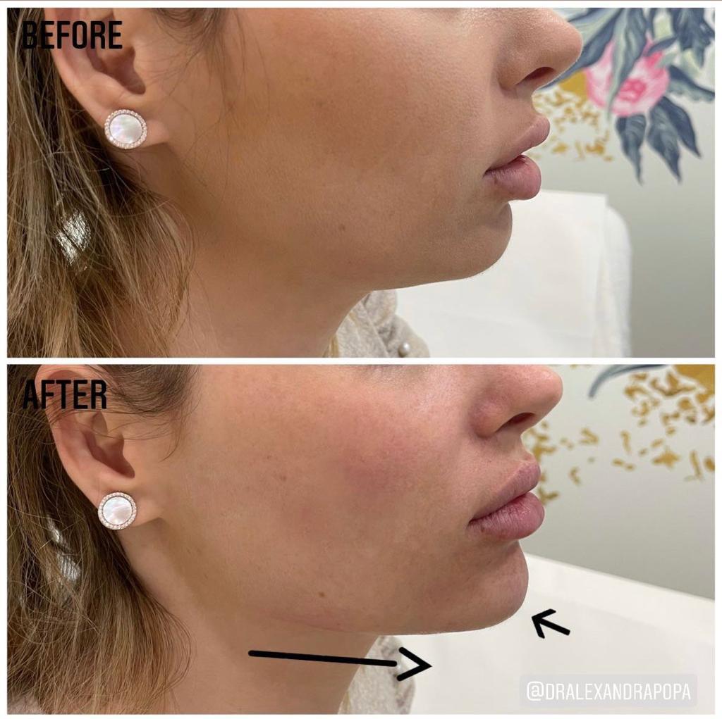 injectari acid hialuronic alderma constanta 22 (4)