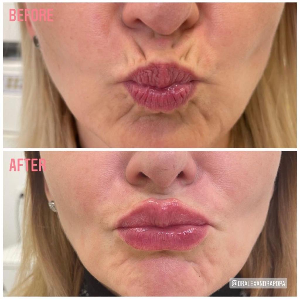 tratarea ridurilor adanci cu botox alderma constanta (1)