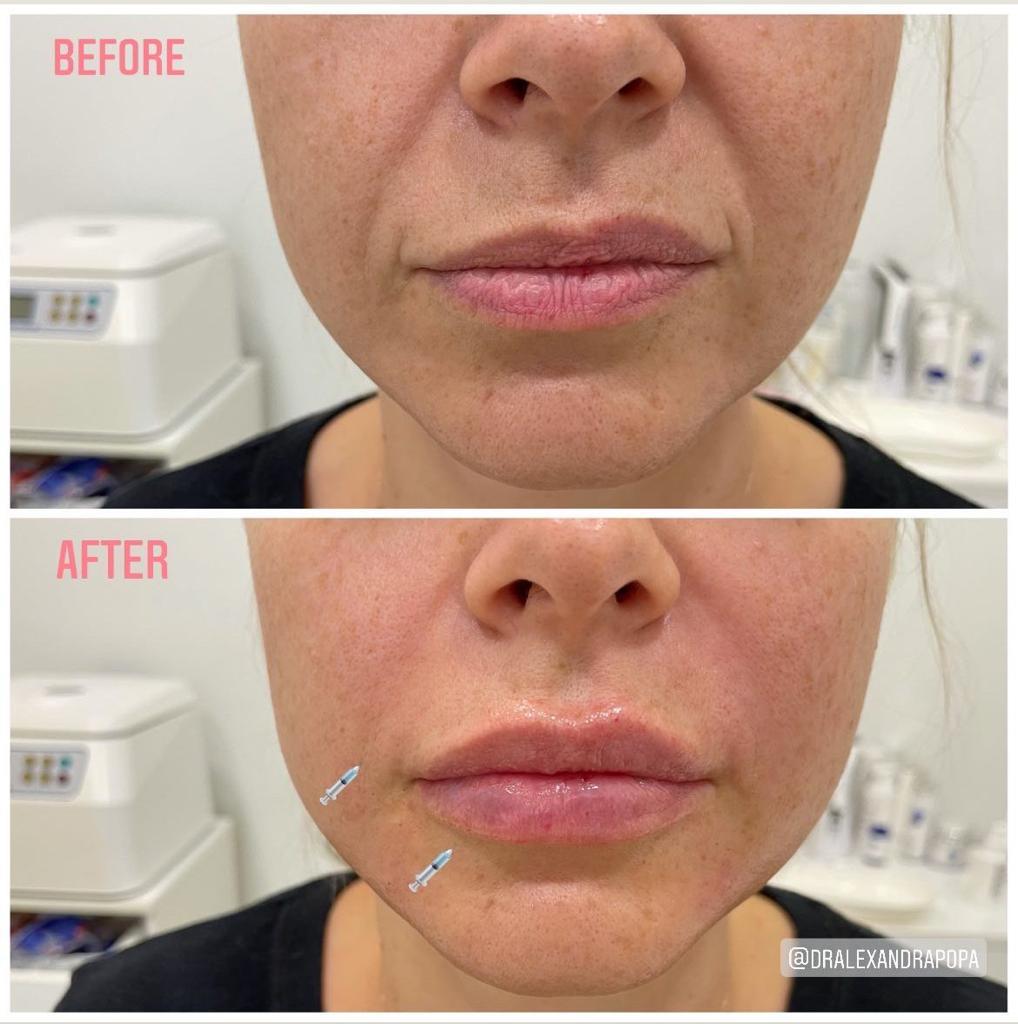 tratarea ridurilor adanci cu botox alderma constanta (2)