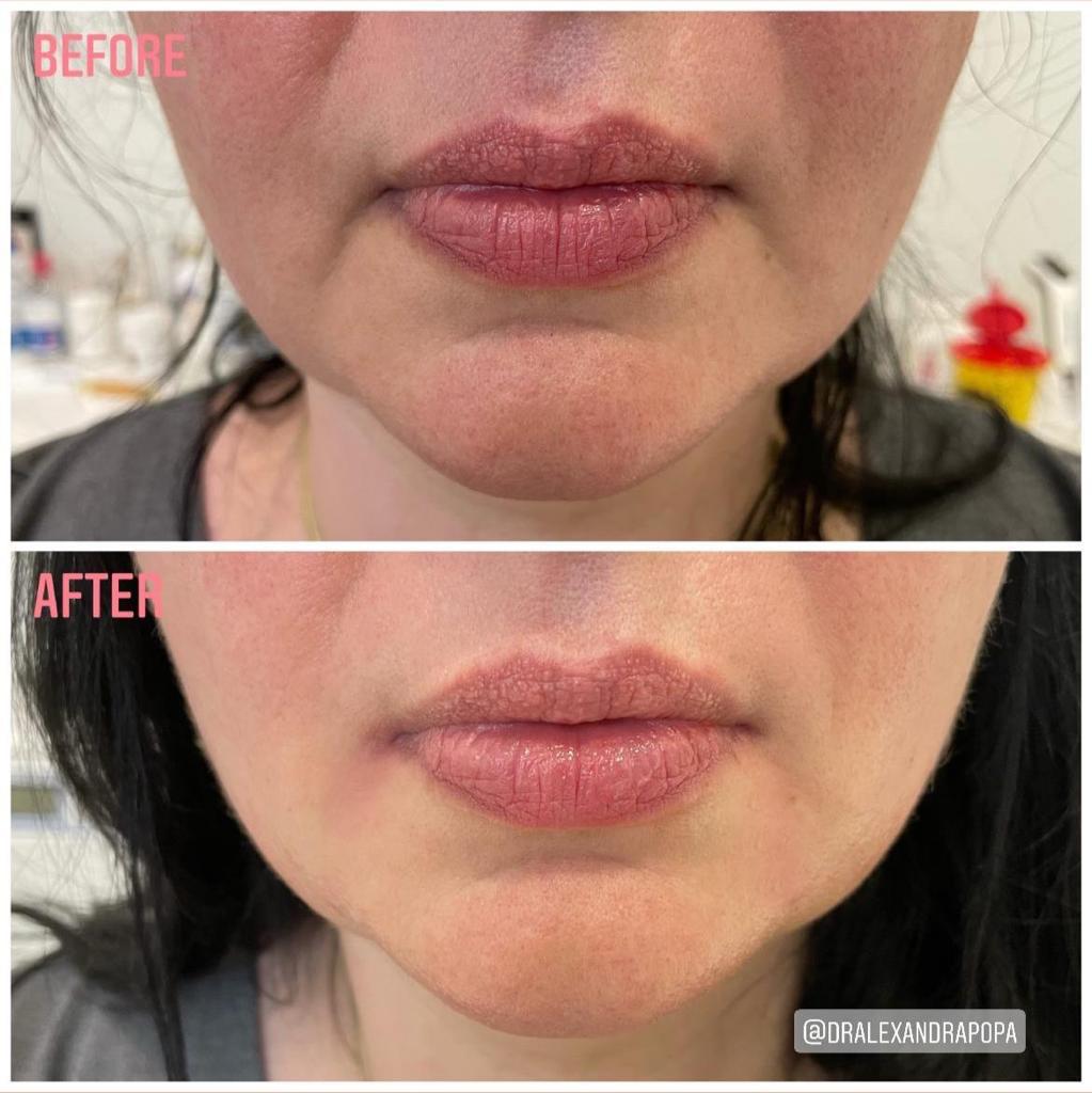 tratarea ridurilor adanci cu botox alderma constanta (3)