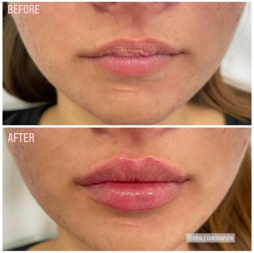 injectari-acid-hialuronic-marire-buze-alderma-constanta-1