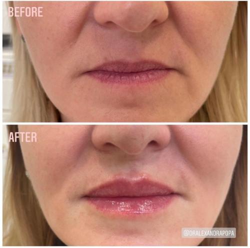 injectari-acid-hialuronic-marire-buze-alderma-constanta-2