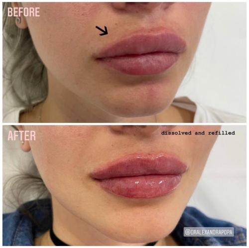 injectari-acid-hialuronic-marire-buze-alderma-constanta-4