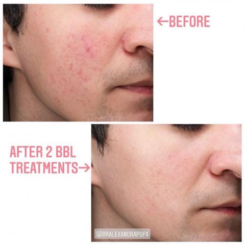 rejuvenare-faciala-bbl-laser-alderma-constanta-1
