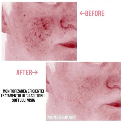 rejuvenare-faciala-bbl-laser-alderma-constanta-2