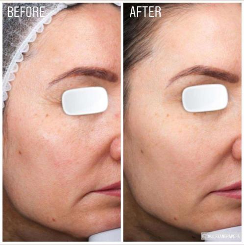 skin-boosters-alderma-constanta-1