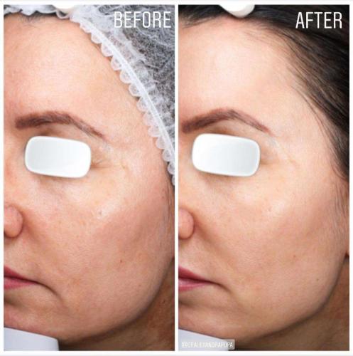 skin-boosters-alderma-constanta-2