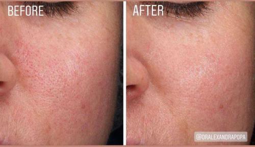 skin-boosters-alderma-constanta-3